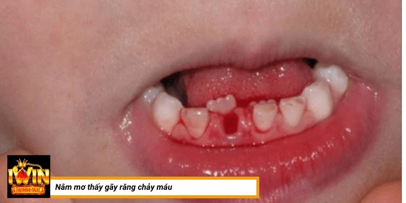 Nằm mơ thấy gãy răng chảy máu